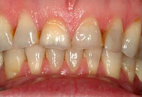 Granger Dentistry | Crowns  amp  Caps, Ceramic Crowns and Emergency Treatment